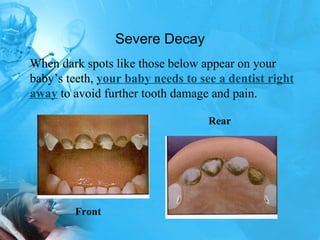 Severe Decay Rear Front When dark spots like those below appear on your baby’s teeth,  your baby needs to see a dentist right away  to avoid further tooth damage and pain. 