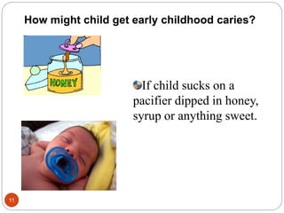 How might child get early childhood caries?
If child sucks on a
pacifier dipped in honey,
syrup or anything sweet.
11
 
