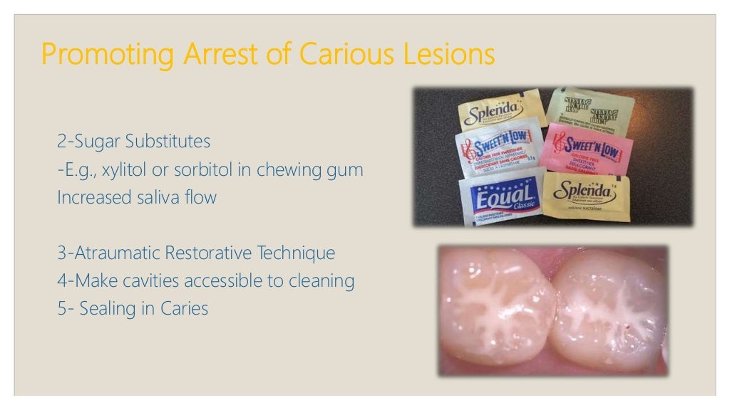 Early childhood caries, rampant, chronic and arrested caries