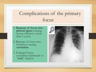 Complications of the primary 
focus 
1. Rupture of focus into 
pleural space causing 
serous effusion ( more 
than 5 years) 
2. Rupture of focus into 
bronchus causing 
cavitation 
3. Enlarged focus, 
sometimes laminated or 
“coin” shadow 
 