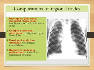 Complications of regional nodes 
1. Incomplete (ball-valve) 
bronchial obstruction, 
emphysema of middle & lower 
lobes 
2. Complete bronchial 
obstruction, collapse of right 
lower lobe 
3. Erosion of node into 
bronchus & segmental 
consolidation 
4. Rupture of node into 
pericardium: tuberculous 
pericardial effusion 
 