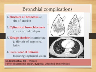 Bronchial complications 
1. Stricture of bronchus at 
site of erosion 
2. Cylindrical bronchiectasis 
in area of old collapse 
3. Wedge shadow: contracture 
& fibrosis of segmental 
lesion 
4. Linear scar of fibrosis 
following segmental lesion 
Endobronchial TB – wheeze 
Fever, troublesome cough, dyspnea, wheezing and cyanosis 
 