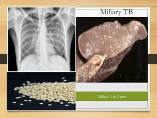 Miliary TB 
Millets- 1 to 3 mm 
 