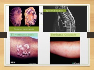 Spinal tuberculosis 
Skin manifestations 
Casseous tuberculosis 
TB verrucous cutis Erythema Nodosum 
 