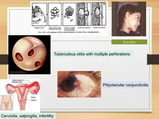 ) 
Scrofula 
Phlyctenular conjunctivitis 
Cervicitis, salpingitis, infertility 
Tuberculous otitis with multiple perforations 
 