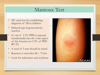 Mantoux Test 
• MC used test for establishing 
diagnosis of TB in children 
• Delayed type hypersensitivity 
reaction 
• 0.1 ml of 5 TU PPD is injected 
intradermally into the volar aspect 
of the forearm (or 2 TU of PPD 
RT 23) 
• A weal of 5 mm should be raised 
• Reaction is read after 48 – 72 hrs 
• Look for induration and erythema 
 