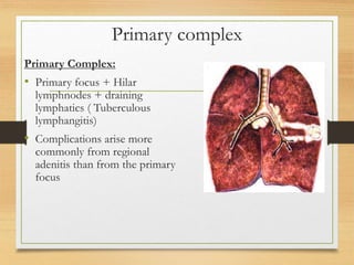 Primary complex 
Primary Complex: 
• Primary focus + Hilar 
lymphnodes + draining 
lymphatics ( Tuberculous 
lymphangitis) 
• Complications arise more 
commonly from regional 
adenitis than from the primary 
focus 
 