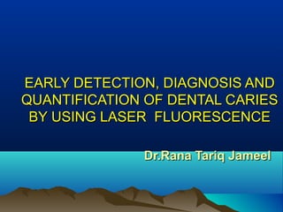 EARLY DETECTION, DIAGNOSIS ANDEARLY DETECTION, DIAGNOSIS AND
QUANTIFICATION OF DENTAL CARIESQUANTIFICATION OF DENTAL CARIES
BY USING LASER FLUORESCENCEBY USING LASER FLUORESCENCE
Dr.Rana Tariq JameelDr.Rana Tariq Jameel
 