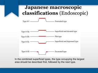 Japanese macroscopic 
classifications (Endoscopic) 
In the combined superficial types, the type occupying the largest 
area should be described first, followed by the next type. 
 