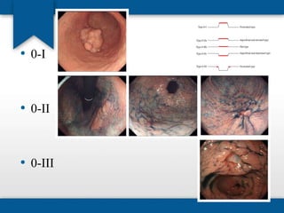 • 0-I 
• 0-II 
• 0-III 
 