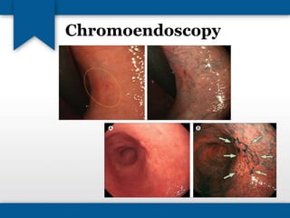 Chromoendoscopy 
 