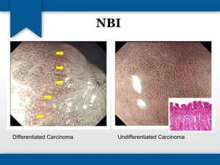 NBI 
Differentiated Carcinoma Undifferentiated Carcinoma 
 