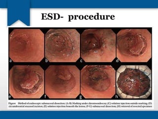 ESD- procedure 
• 
 