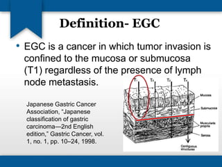 Definition- EGC 
• EGC is a cancer in which tumor invasion is 
confined to the mucosa or submucosa 
(T1) regardless of the presence of lymph 
node metastasis. 
Japanese Gastric Cancer 
Association, “Japanese 
classification of gastric 
carcinoma—2nd English 
edition,” Gastric Cancer, vol. 
1, no. 1, pp. 10–24, 1998. 
 