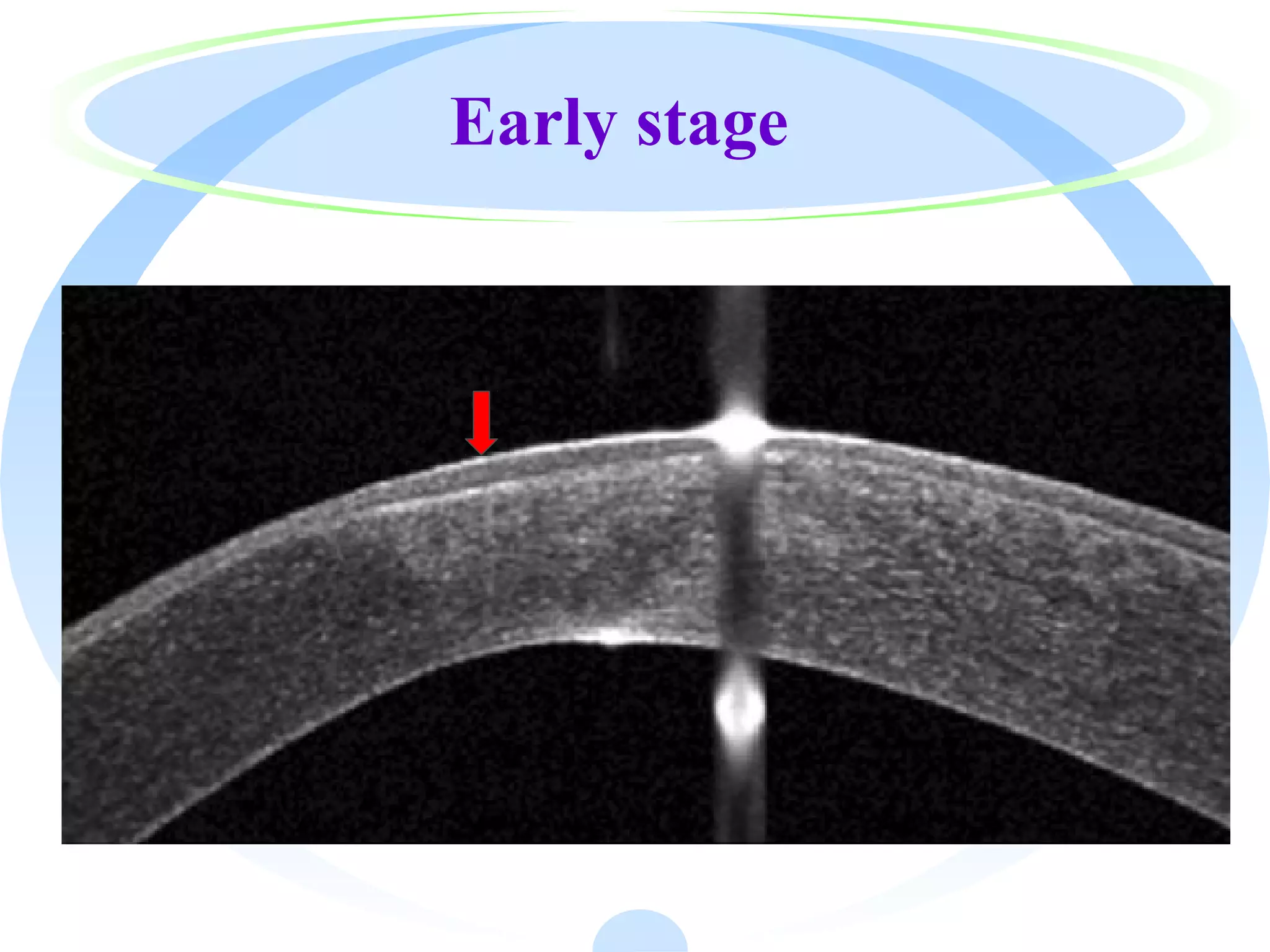 Early Keratoconus Detection Ppt