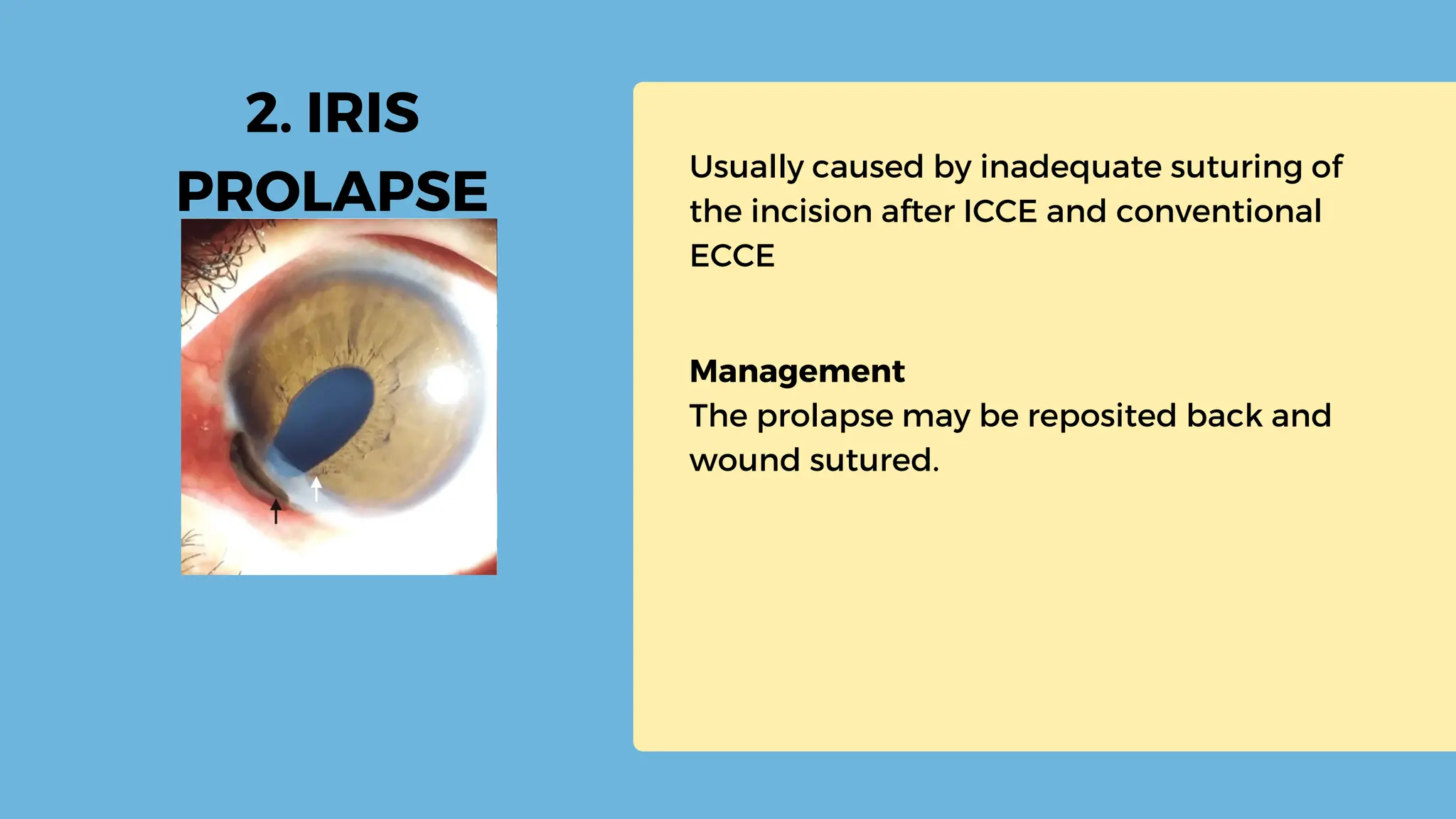 early-post-operative-complications-of-cataract-surgery-20230914-004137