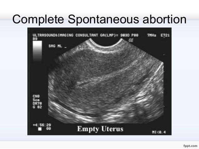 test h-mole pregnancy positive Early pregnancy