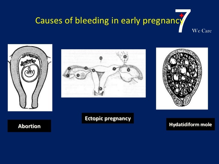 Early Pregnancy Bleeding ppt early-pregnancy-bleeding-ppt