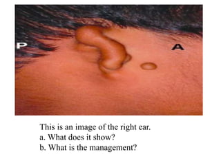 This is an image of the right ear.
a. What does it show?
b. What is the management?
 