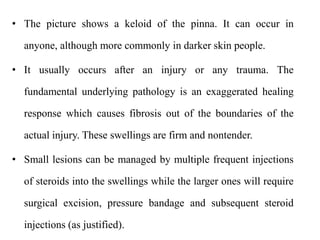 • The picture shows a keloid of the pinna. It can occur in
anyone, although more commonly in darker skin people.
• It usually occurs after an injury or any trauma. The
fundamental underlying pathology is an exaggerated healing
response which causes fibrosis out of the boundaries of the
actual injury. These swellings are firm and nontender.
• Small lesions can be managed by multiple frequent injections
of steroids into the swellings while the larger ones will require
surgical excision, pressure bandage and subsequent steroid
injections (as justified).
 