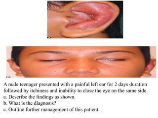 A male teenager presented with a painful left ear for 2 days duration
followed by itchiness and inability to close the eye on the same side.
a. Describe the findings as shown.
b. What is the diagnosis?
c. Outline further management of this patient.
 