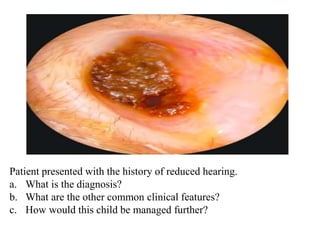 Patient presented with the history of reduced hearing.
a. What is the diagnosis?
b. What are the other common clinical features?
c. How would this child be managed further?
 
