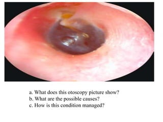 a. What does this otoscopy picture show?
b. What are the possible causes?
c. How is this condition managed?
 