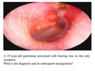 A 25-year-old gentleman presented with hearing loss as the only
symptom.
What is the diagnosis and its subsequent management?
 