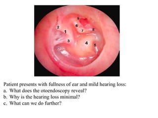 Patient presents with fullness of ear and mild hearing loss:
a. What does the otoendoscopy reveal?
b. Why is the hearing loss minimal?
c. What can we do further?
 