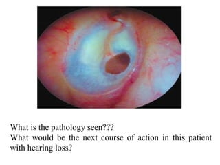 What is the pathology seen???
What would be the next course of action in this patient
with hearing loss?
 