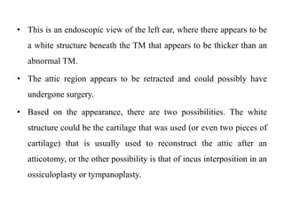• This is an endoscopic view of the left ear, where there appears to be
a white structure beneath the TM that appears to be thicker than an
abnormal TM.
• The attic region appears to be retracted and could possibly have
undergone surgery.
• Based on the appearance, there are two possibilities. The white
structure could be the cartilage that was used (or even two pieces of
cartilage) that is usually used to reconstruct the attic after an
atticotomy, or the other possibility is that of incus interposition in an
ossiculoplasty or tympanoplasty.
 