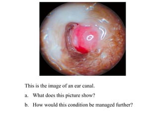 This is the image of an ear canal.
a. What does this picture show?
b. How would this condition be managed further?
 