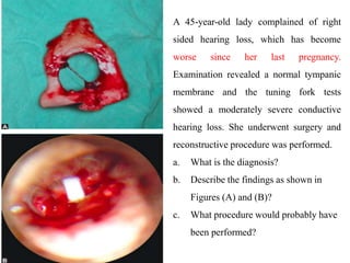 A 45-year-old lady complained of right
sided hearing loss, which has become
worse since her last pregnancy.
Examination revealed a normal tympanic
membrane and the tuning fork tests
showed a moderately severe conductive
hearing loss. She underwent surgery and
reconstructive procedure was performed.
a. What is the diagnosis?
b. Describe the findings as shown in
Figures (A) and (B)?
c. What procedure would probably have
been performed?
 