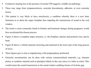  Conductive hearing loss in the presence of normal TM suggests a middle ear pathology.
 These may range from tympanosclerosis, ossicular discontinuity, adhesion, or even ossicular
fusion.
 This patient is very likely to have otosclerosis, a condition whereby there is a new bone
formation at or about the stapes footplate thus impeding the transmission of sound to the oval
window.
 The lesion is more commonly found in females and hormonal changes during pregnancy would
have accelerated the disease process.
 Figure A shows a complete stapes structure, i.e. the footplate, anterior and posterior crus, and its
head.
 Figure B shows a whitish material encircling and anchored at the lower part of the long process
of incus.
 These figures gave a clue to stapedectomy with tympanoplasty performed.
 Ossicular reconstruction can be done with various commercialized materials, e.g. titanium
piston, or synthetic material such as plastipore (likely in this case since it is white in color). This
would restore the sound transmission to the round window enabling closure of air-bone gap.
 
