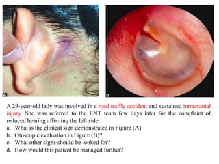 A 29-year-old lady was involved in a road traffic accident and sustained intracranial
injury. She was referred to the ENT team few days later for the complaint of
reduced hearing affecting the left side.
a. What is the clinical sign demonstrated in Figure (A)
b. Otoscopic evaluation in Figure (B)?
c. What other signs should be looked for?
d. How would this patient be managed further?
 