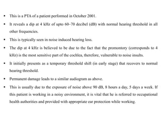  This is a PTA of a patient performed in October 2001.
 It reveals a dip at 4 kHz of upto 60–70 decibel (dB) with normal hearing threshold in all
other frequencies.
 This is typically seen in noise induced hearing loss.
 The dip at 4 kHz is believed to be due to the fact that the promontory (corresponds to 4
kHz) is the most sensitive part of the cochlea, therefore, vulnerable to noise insults.
 It initially presents as a temporary threshold shift (in early stage) that recovers to normal
hearing threshold.
 Permanent damage leads to a similar audiogram as above.
 This is usually due to the exposure of noise above 90 dB, 8 hours a day, 5 days a week. If
this patient is working in a noisy environment, it is vital that he is referred to occupational
health authorities and provided with appropriate ear protection while working.
 