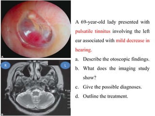 A 69-year-old lady presented with
pulsatile tinnitus involving the left
ear associated with mild decrease in
hearing.
a. Describe the otoscopic findings.
b. What does the imaging study
show?
c. Give the possible diagnoses.
d. Outline the treatment.
L
R
 