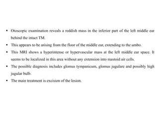 Otoscopic examination reveals a reddish mass in the inferior part of the left middle ear
behind the intact TM.
 This appears to be arising from the floor of the middle ear, extending to the umbo.
 This MRI shows a hyperintense or hypervascular mass at the left middle ear space. It
seems to be localized in this area without any extension into mastoid air cells.
 The possible diagnosis includes glomus tympanicum, glomus jugulare and possibly high
jugular bulb.
 The main treatment is excision of the lesion.
 