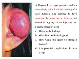 A 17-year-old teenager presented with an
increasingly painful left ear swelling of 5
days duration. She admitted to have
scratched the pinna due to itchiness, but
denied having any recent injury or ear
piercing procedure done.
a. Describe the findings.
b. Give the most likely diagnosis.
c. How would this lesion be managed
further?
d. List potential complications that can
occur.
 