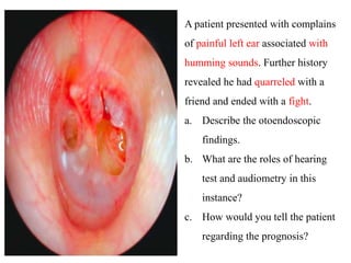 A patient presented with complains
of painful left ear associated with
humming sounds. Further history
revealed he had quarreled with a
friend and ended with a fight.
a. Describe the otoendoscopic
findings.
b. What are the roles of hearing
test and audiometry in this
instance?
c. How would you tell the patient
regarding the prognosis?
 