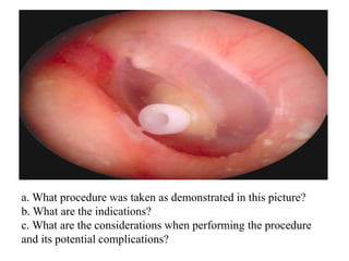 a. What procedure was taken as demonstrated in this picture?
b. What are the indications?
c. What are the considerations when performing the procedure
and its potential complications?
 
