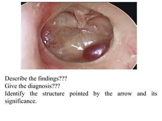 Describe the findings???
Give the diagnosis???
Identify the structure pointed by the arrow and its
significance.
 