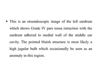  This is an otoendoscopic image of the left eardrum
which shows Grade IV pars tensa retraction with the
eardrum adhered to medial wall of the middle ear
cavity. The pointed bluish structure is most likely a
high jugular bulb which occasionally be seen as an
anomaly in this region.
 