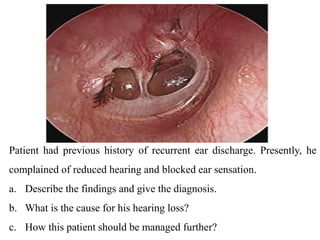 Patient had previous history of recurrent ear discharge. Presently, he
complained of reduced hearing and blocked ear sensation.
a. Describe the findings and give the diagnosis.
b. What is the cause for his hearing loss?
c. How this patient should be managed further?
 