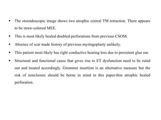  The otoendoscopic image shows two atrophic central TM retraction. There appears
to be straw-colored MEE.
 This is most likely healed doubled perforations from previous CSOM.
 Absence of scar made history of previous myringoplasty unlikely.
 This patient most likely has right conductive hearing loss due to persistent glue ear.
 Structural and functional cause that gives rise to ET dysfunction need to be ruled
out and treated accordingly. Grommet insertion is an alternative measure but the
risk of nonclosure should be borne in mind in this paper-thin atrophic healed
perforation.
 