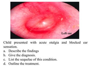 Child presented with acute otalgia and blocked ear
sensation.
a. Describe the findings
b. Give the diagnosis.
c. List the sequelae of this condition.
d. Outline the treatment.
Left ear
 