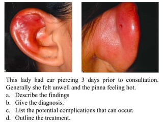 This lady had ear piercing 3 days prior to consultation.
Generally she felt unwell and the pinna feeling hot.
a. Describe the findings
b. Give the diagnosis.
c. List the potential complications that can occur.
d. Outline the treatment.
 