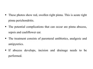  These photos show red, swollen right pinna. This is acute right
pinna perichondritis.
 The potential complications that can occur are pinna abscess,
sepsis and cauliflower ear.
 The treatment consists of parenteral antibiotics, analgesic and
antipyretics.
 If abscess develops, incision and drainage needs to be
performed.
 