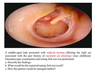 A middle-aged lady presented with reduced hearing affecting the right ear
associated with the past history of recurrent ear discharge since childhood.
Otoendoscopic examination and tuning fork test was performed.
a. Describe the findings.
b. What would be the expected tuning fork test result?
c. How this patient would be managed further?
 