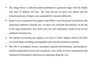  The image shows a subtotal central perforation in quiescent stage with the handle
and neck of malleus left bare. The long process of incus was absent and the
lenticular process of stapes seen surrounded by mucosal adhesions.
 Rinne’s test is expected to be negative and Weber’s test lateralized to ipsilateral side
indicating conductive hearing loss. As there was ossicular discontinuity on the top
of the large perforation, free field voice test and audiometry would reveal severe
conductive hearing loss.
 The options are hearing aid, surgery, or to leave it alone. Surgery needs to be done
at several stages including myringoplasty and ossicular prosthesis insertion.
 The risk of incomplete closure, secondary acquired cholesteatoma, and prosthesis-
related complications need to be considered. Care of the ear from contaminants and
treatment of intercurrent infections are important along the way.
 
